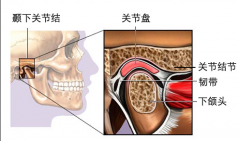 掛鉤炎不治的話會越來越嚴重嗎