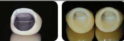 做全瓷牙鬆動了可以固定嗎