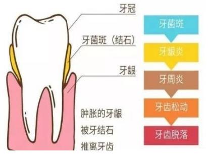 牙周炎腫了