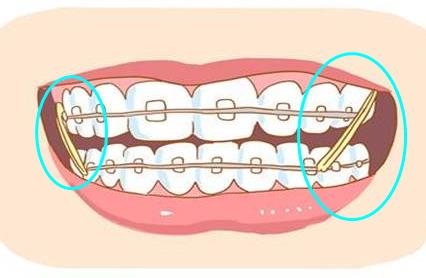牙齒矯正橡皮筋