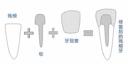 牙齒打樁後做烤瓷牙