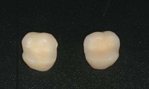 臨(lin) 時的樹脂牙可以帶多長時間