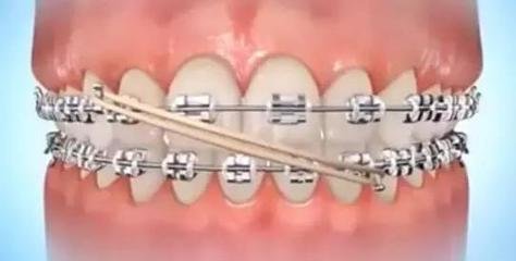 矯正牙齒戴橡皮筋