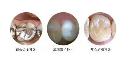 兒(er) 童補蛀牙