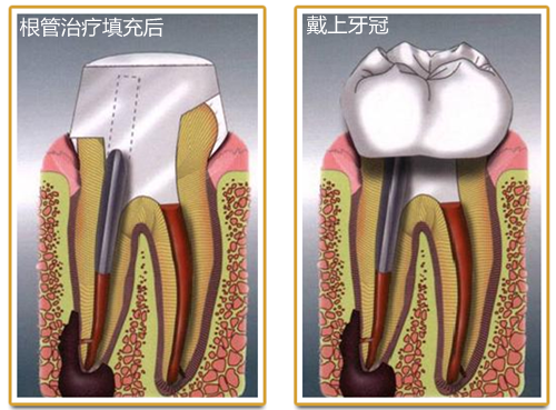 根尖周炎的治療方法