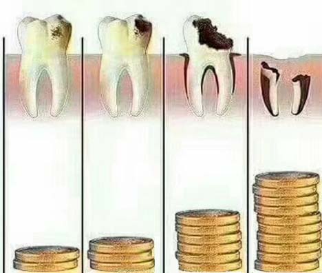 蛀牙是拔牙還是補牙