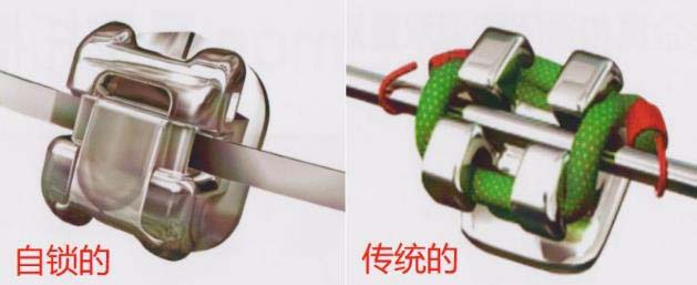 傳(chuan) 統托槽和自鎖托槽