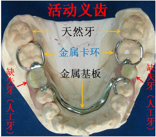 隱形義(yi) 齒**傳(chuan) 統活動假牙哪個(ge) 好