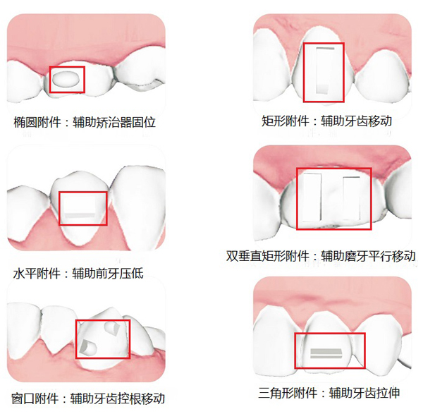 隱形矯治粘附件