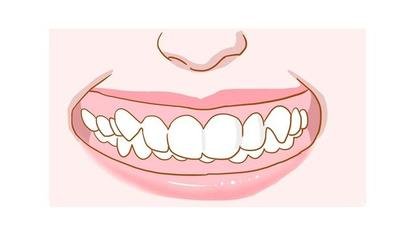 一度深覆合有沒有必要矯正