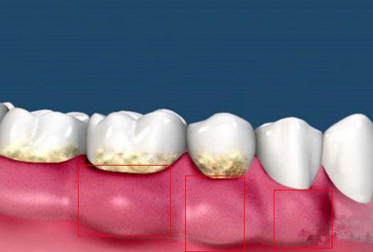 牙縫疙瘩疼痛難忍