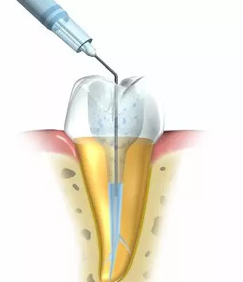 牙齒根管治療需要打麻藥嗎