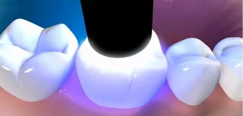 什麽(me) 叫光固化複合樹脂補牙
