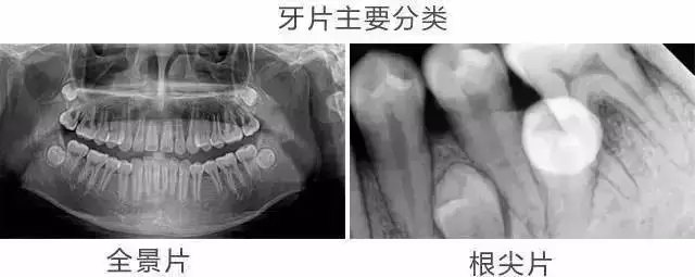 拍全口牙齒x光片多少錢
