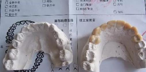 有烤瓷牙能整做隱形矯正嗎