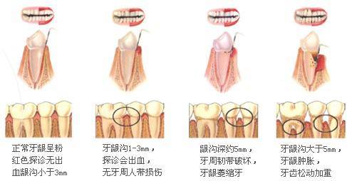 牙周炎刮治需做多少次