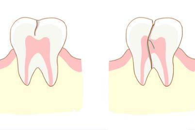 牙齒上有裂紋要治療嗎