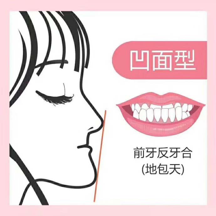 牙齒上下咬合不齊怎麽(me) 辦