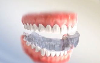 深圳牙齒正畸保持器哪種好