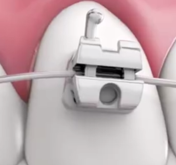 自鎖托槽正畸真的可以縮短矯正時間嗎