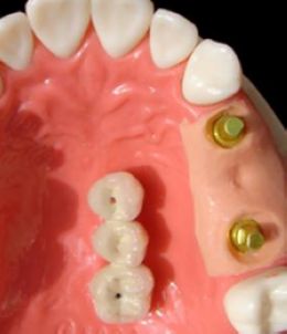 去醫院鑲牙要多少錢一顆