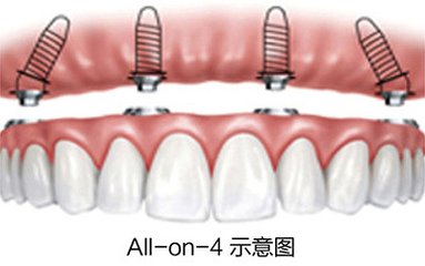  全口牙齒種植需要多少錢