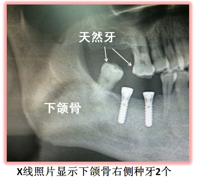 拍種植牙x光片注意事項