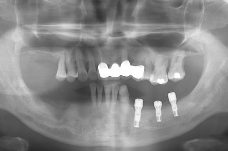 拍口腔全景x光要預約嗎