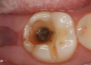 蛀牙很疼，壞掉一大半