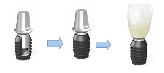 韓國牙齒種植一般多少錢