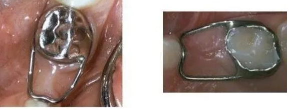 兒(er) 童拔牙後做間隙保持器