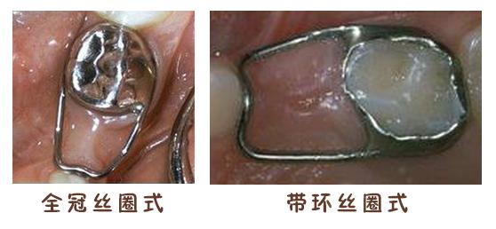  兒(er) 童拔牙後上保持器疼嗎