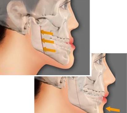 地包天矯正一定要拔牙嗎