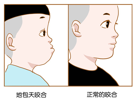 地包天矯正牙齒要多少錢