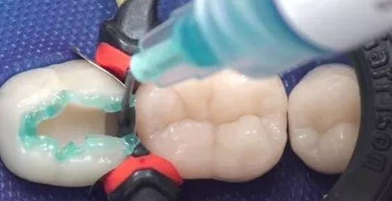玻璃離子補牙大概多少錢