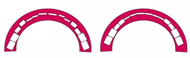 牙齒正畸，到底拔不拔牙