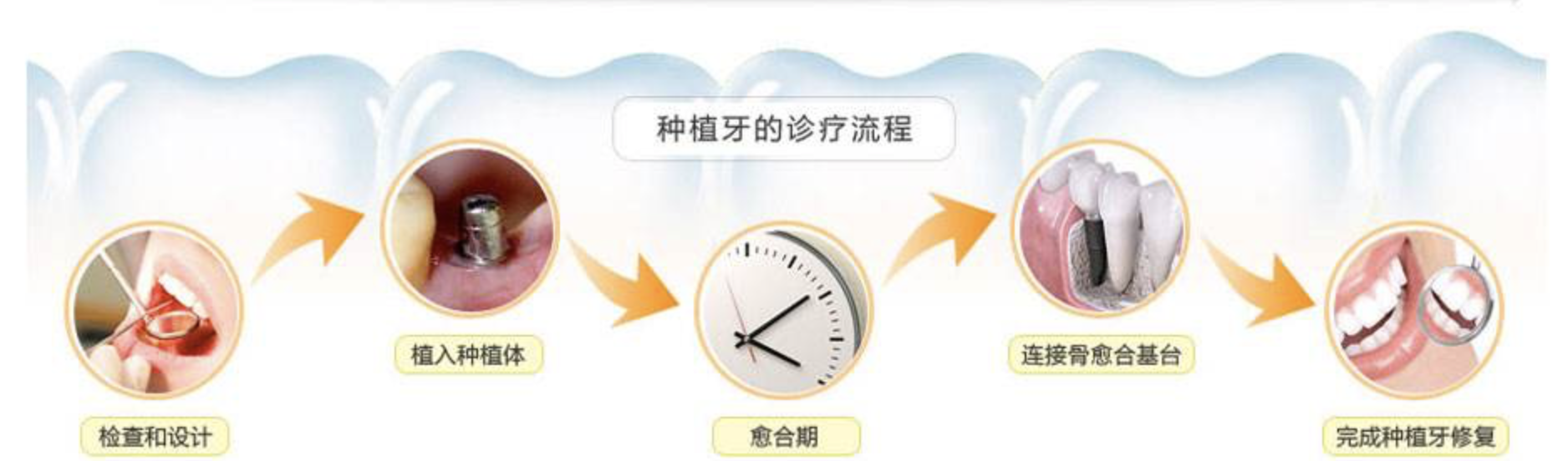 種牙的價(jia) 格多少錢一顆