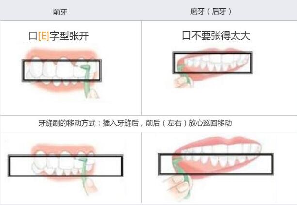 正畸有必要買(mai) 牙縫刷嗎