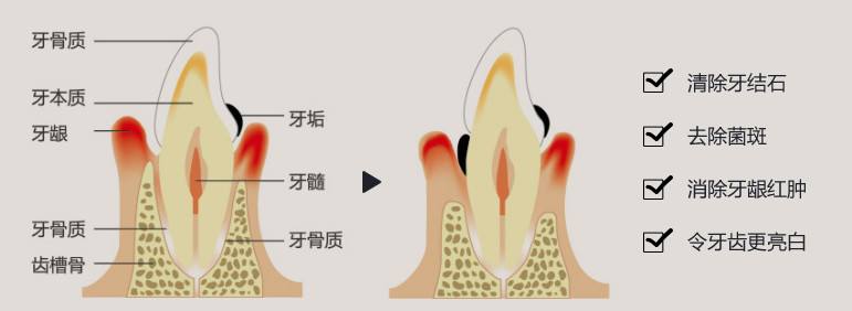 怎麽(me) 清洗牙齒上的汙垢