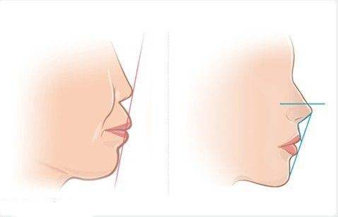 前突牙齒正畸費用是多少