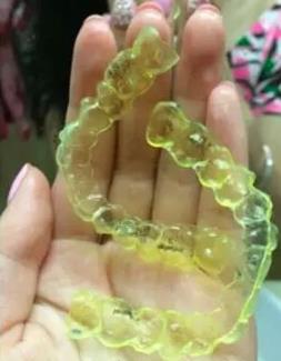牙齒正畸保持器壞了，再做多少錢