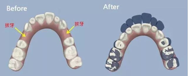 正畸拔牙