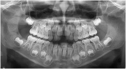 牙列全景圖X光多少錢