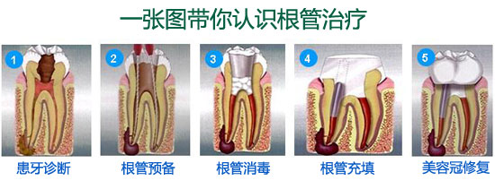 牙根管治療多少錢