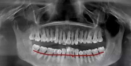 牙齒矯正之前為(wei) 什麽(me) 要拍片