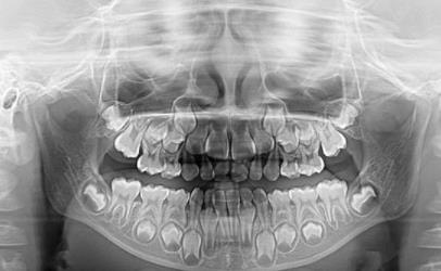混合牙時期拍片