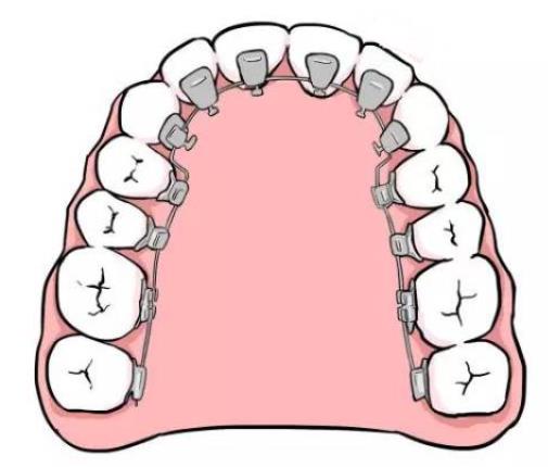 深圳牙齒舌側(ce) 正畸多少錢