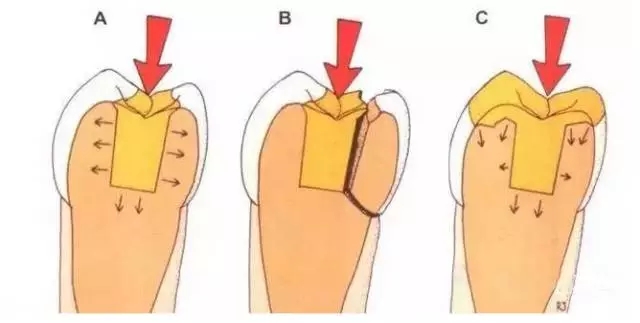 牙齒高嵌體(ti) 是什麽(me) 意思