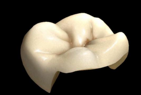 根管治療後做高嵌體(ti) 還是全冠好