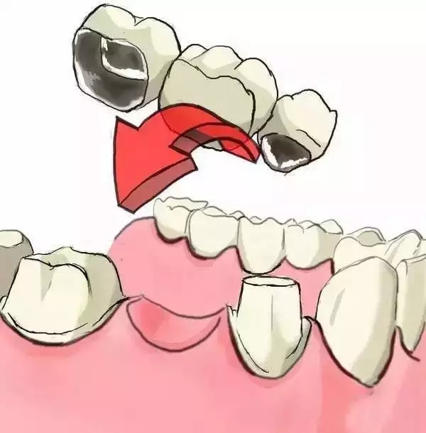 烤瓷牙修複